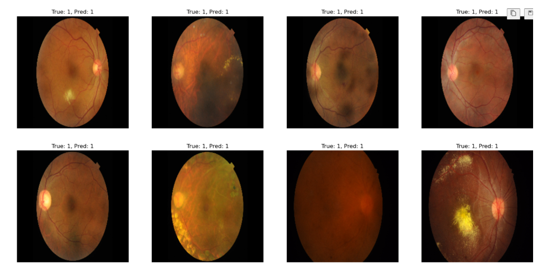 Sağlıklı ve Sağlıksız Retina Optik Disk Görüntüsünün Tanınması